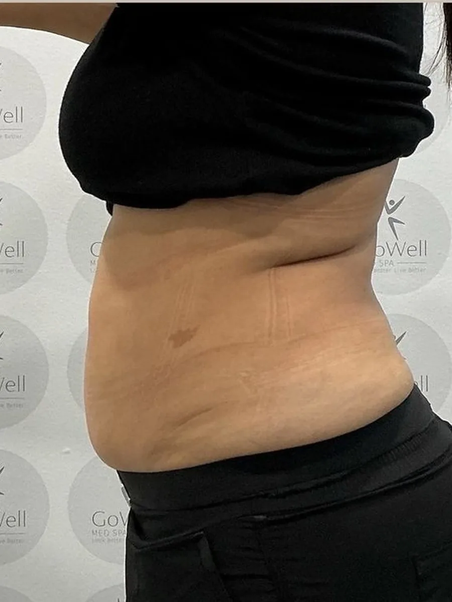 GoWell body contouring client, after – result 8