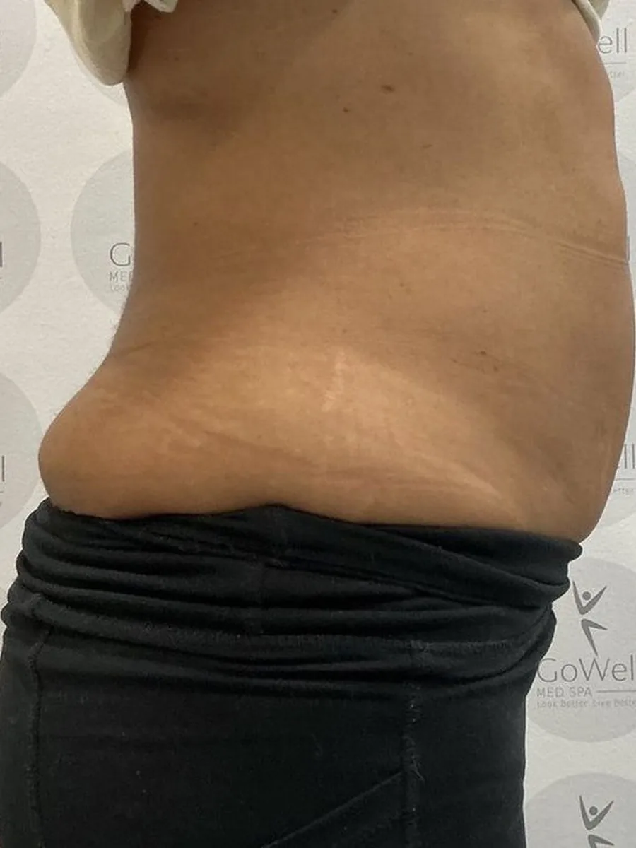 GoWell body contouring client, after – result 6