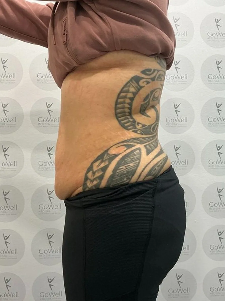 GoWell body contouring client, after – result 4