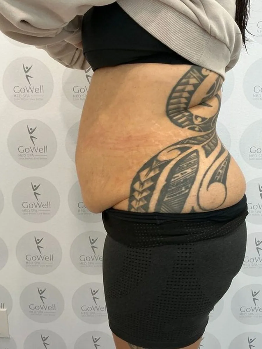 GoWell body contouring client, before – result 4