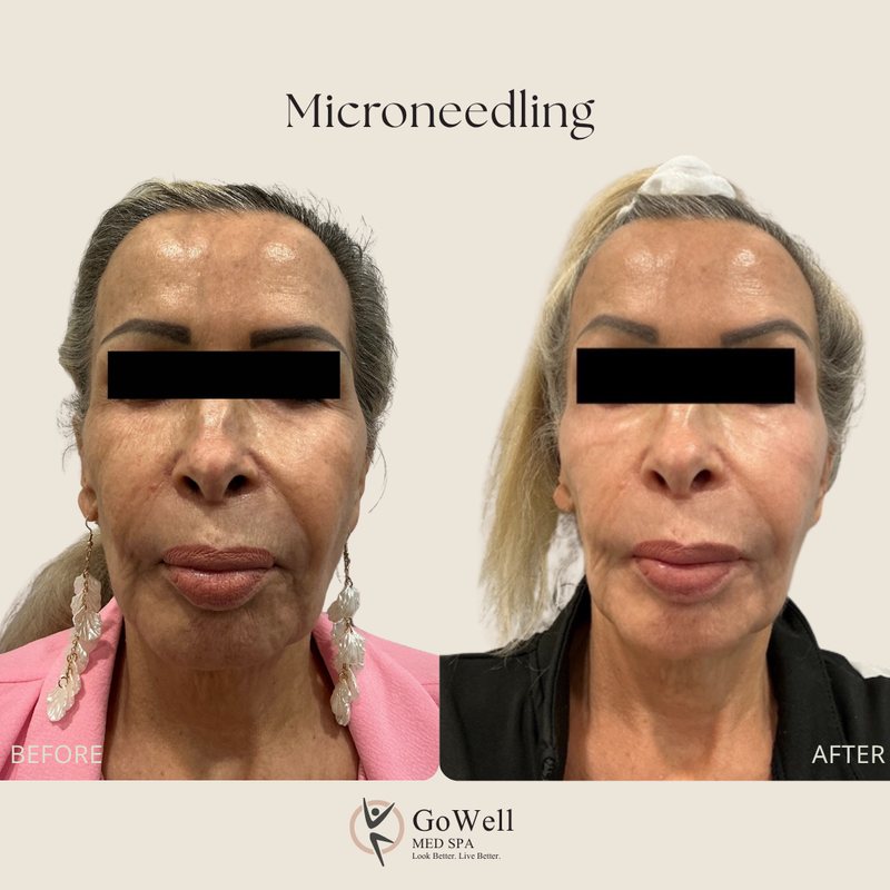Microneedling before and after in Coral Springs — smoother texture and softer lines, front view
