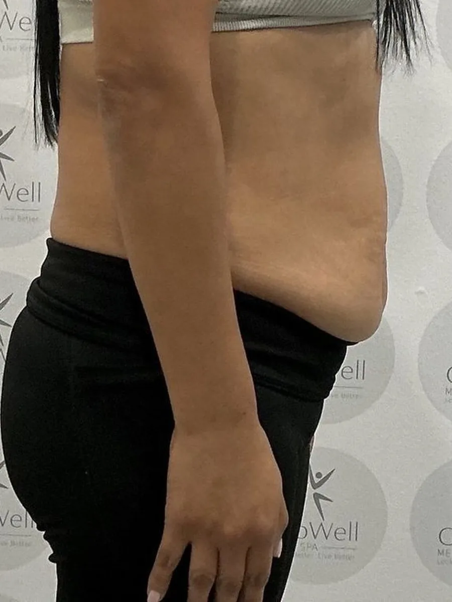 GoWell body contouring client, before – result 2