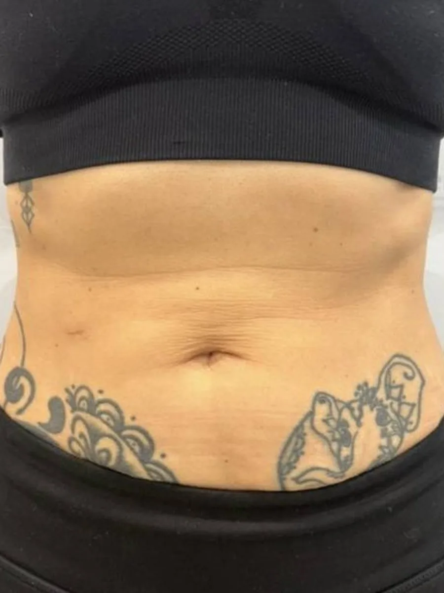GoWell body contouring client, before – result 5