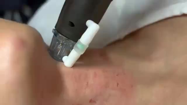 RF microneedling treatment at GoWell