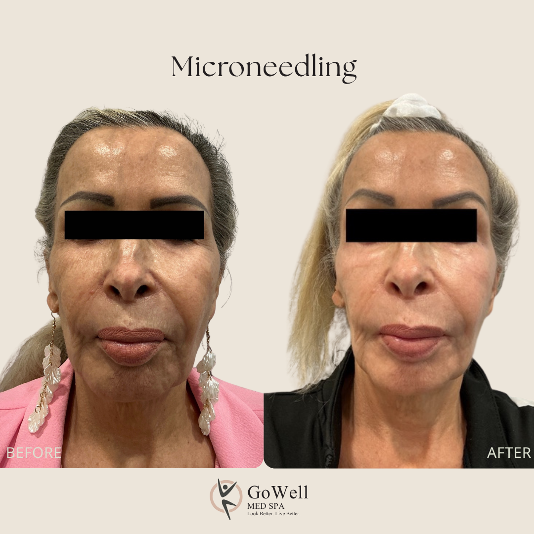 Microneedling before and after — smoother texture and softer lines, front view