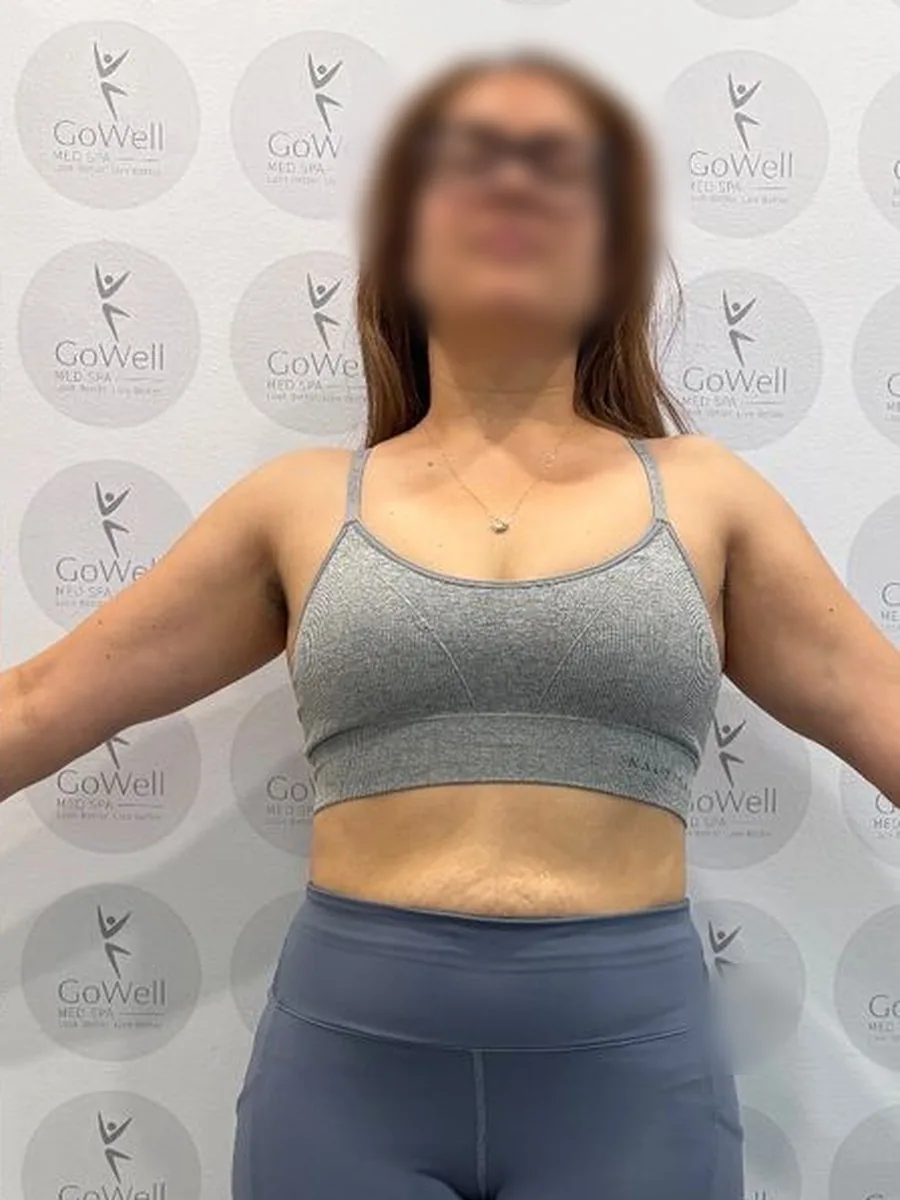GoWell weight loss client, after – result 1