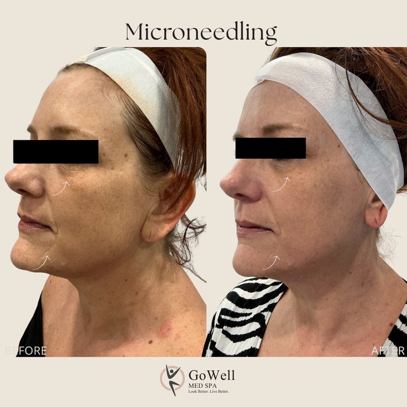 Microneedling before and after in Coral Springs — lifted jawline and even tone, three-quarter view