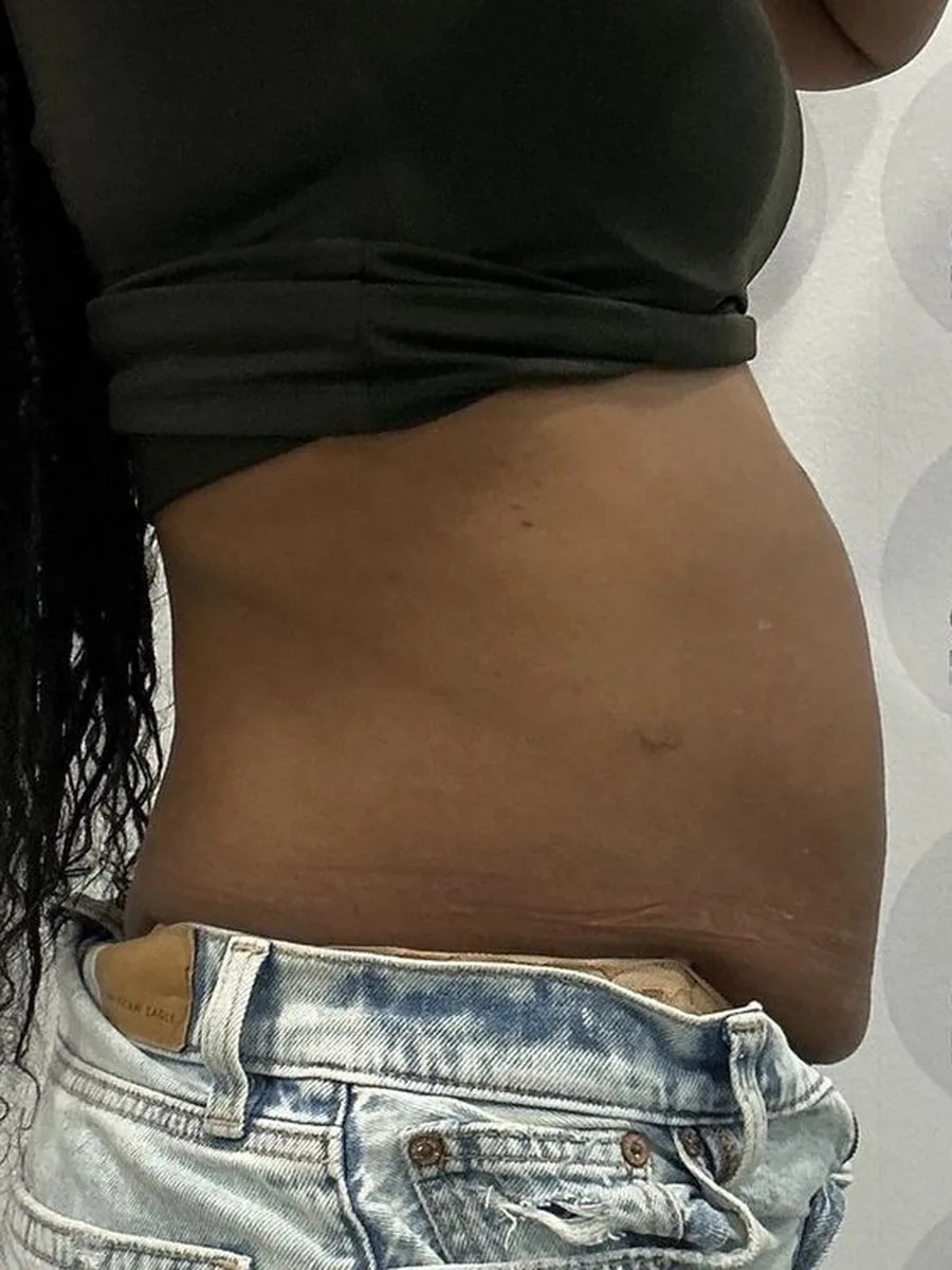 GoWell body contouring client, before – result 7