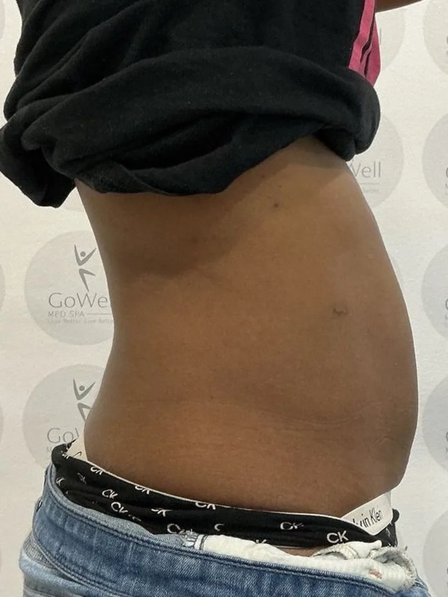 GoWell body contouring client, after – result 7