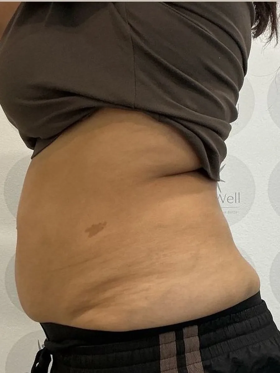 GoWell body contouring client, before – result 8