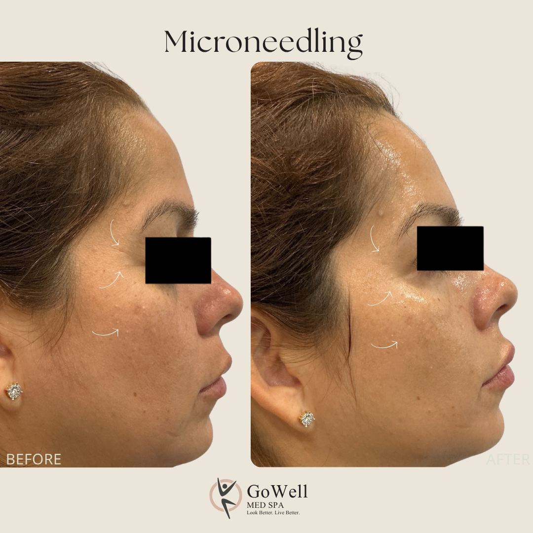 Microneedling before and after — brighter, glowing skin, profile view