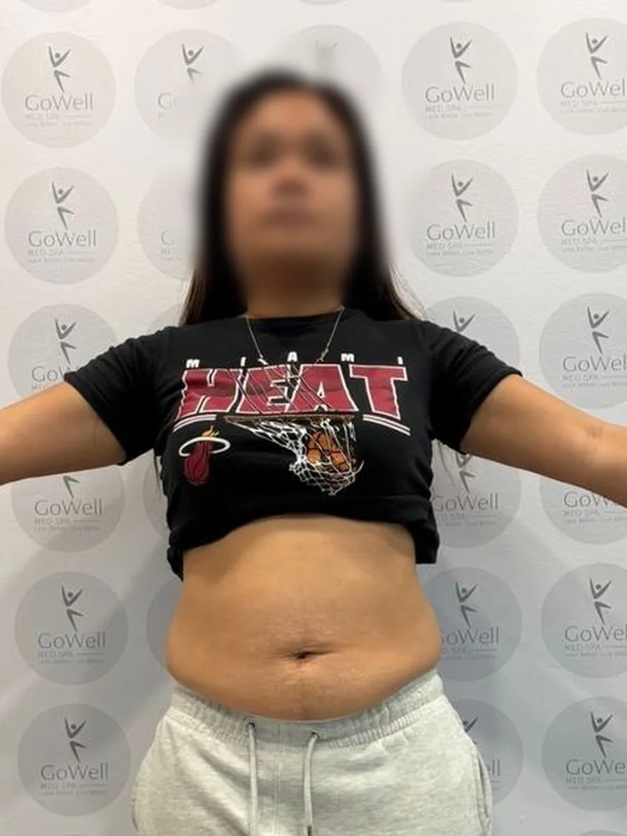 GoWell weight loss client, before – result 3