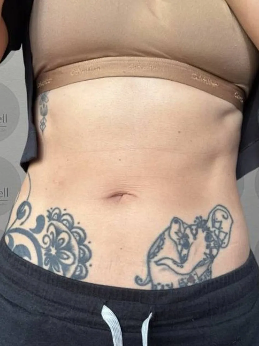 GoWell body contouring client, after – result 5