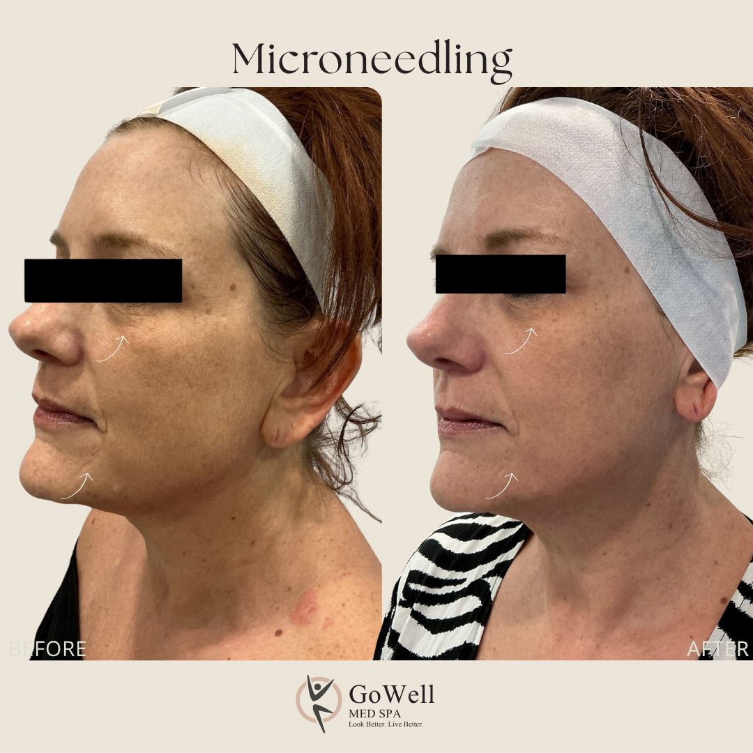 Microneedling before and after — lifted jawline and even tone, three-quarter view