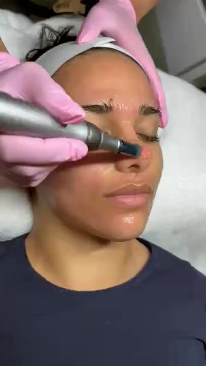 Microneedling treatment at GoWell
