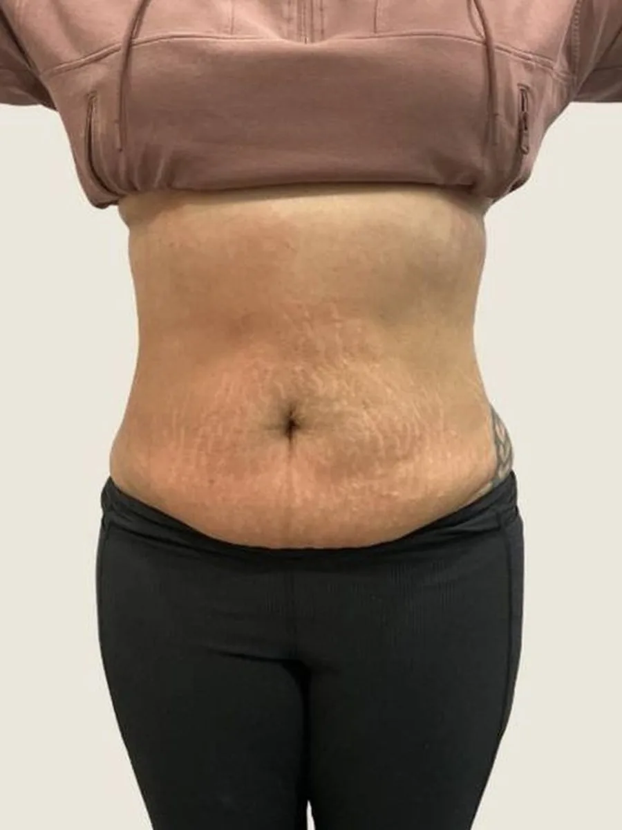 GoWell body contouring client, after – result 3