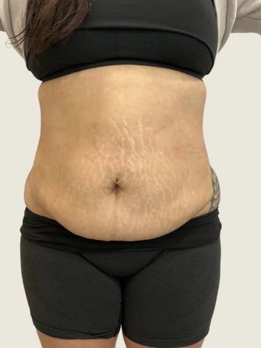 GoWell body contouring client, before – result 3