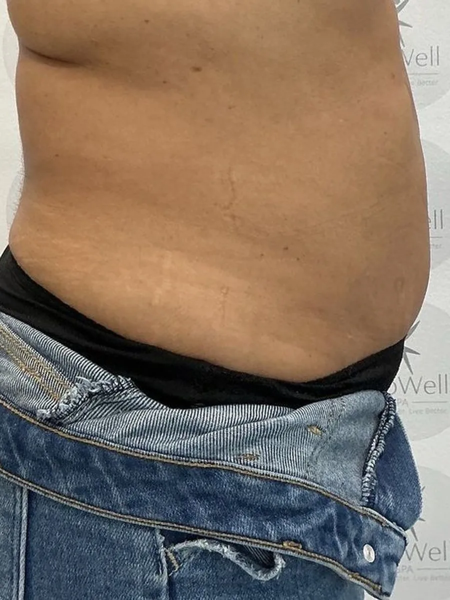 GoWell body contouring client, before – result 6