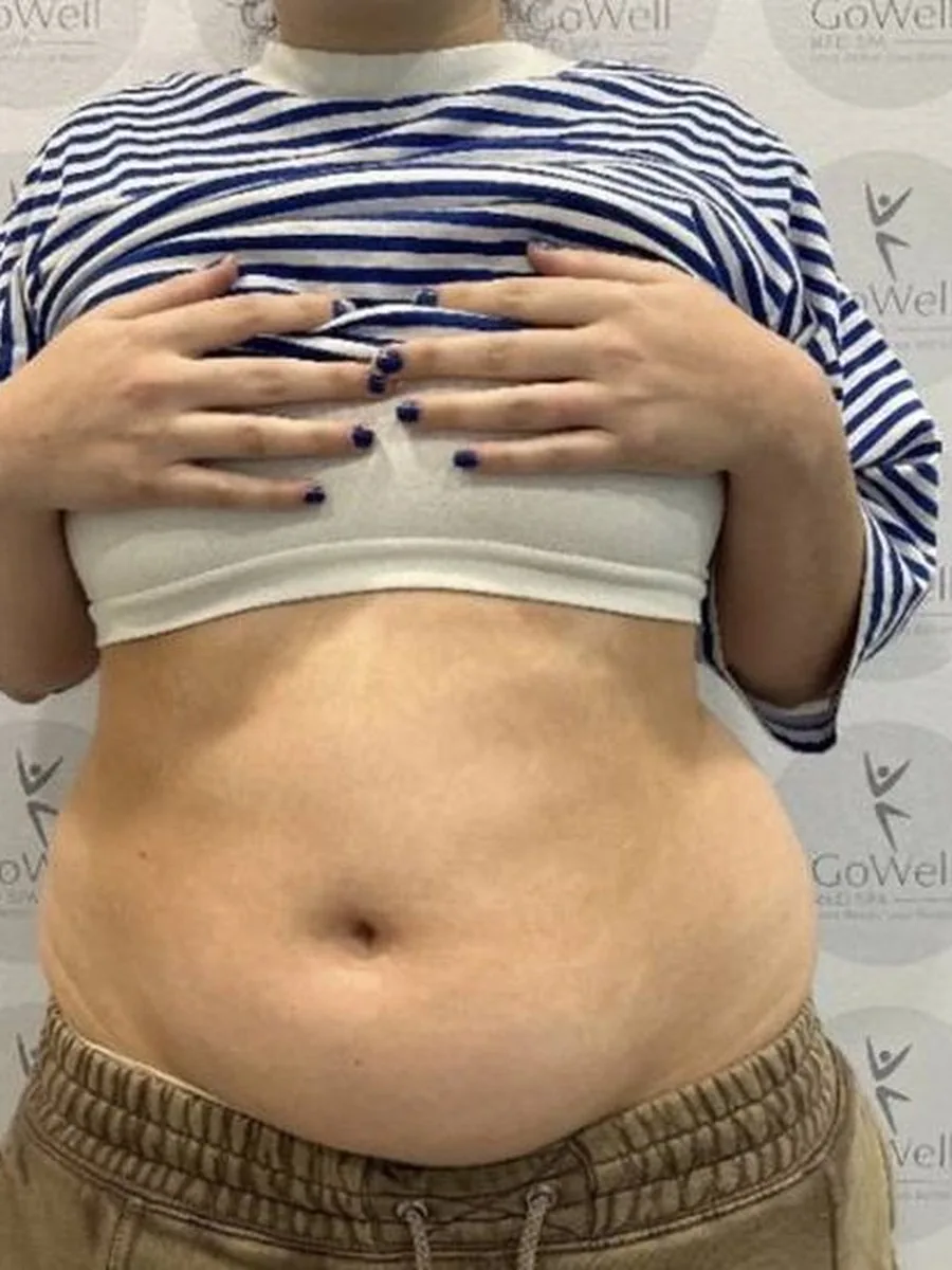GoWell body contouring client, before – result 1